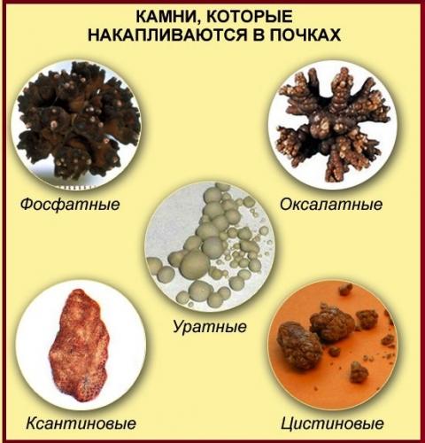 Лечение камней в почках народными средствами