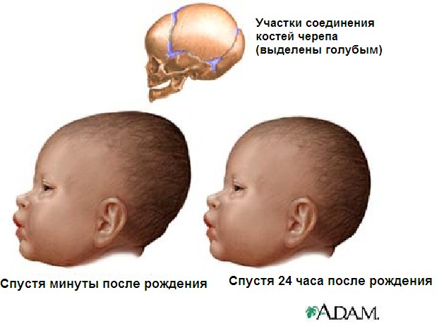 Внутричерепное давление у новорожденных детей