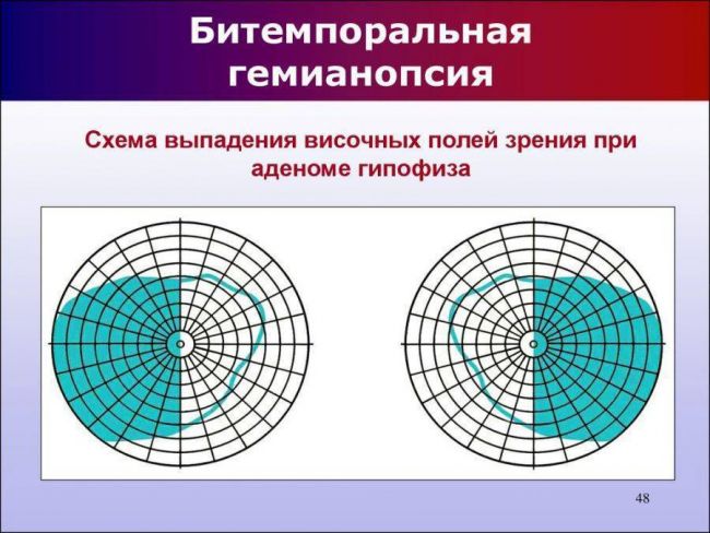 Лечение гемианопсии после инсульта