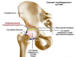 Синовит. причины, симптомы, виды, лечение и реабилитация