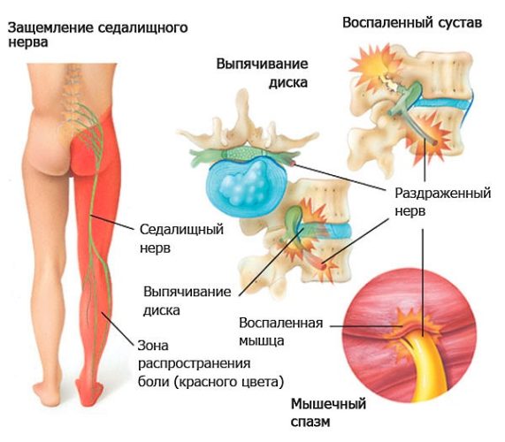 Защемление нерва в пояснице — причины, симптомы и лечение