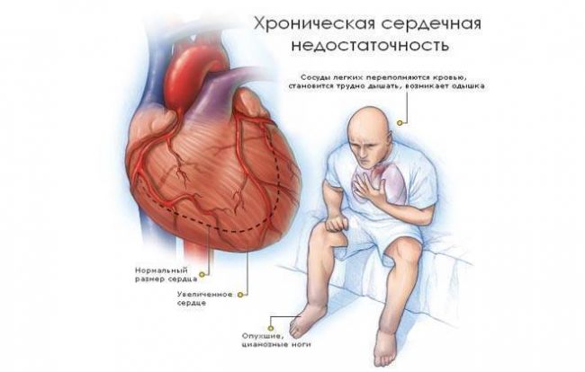 Мокрота с кровью: причины кровохарканья