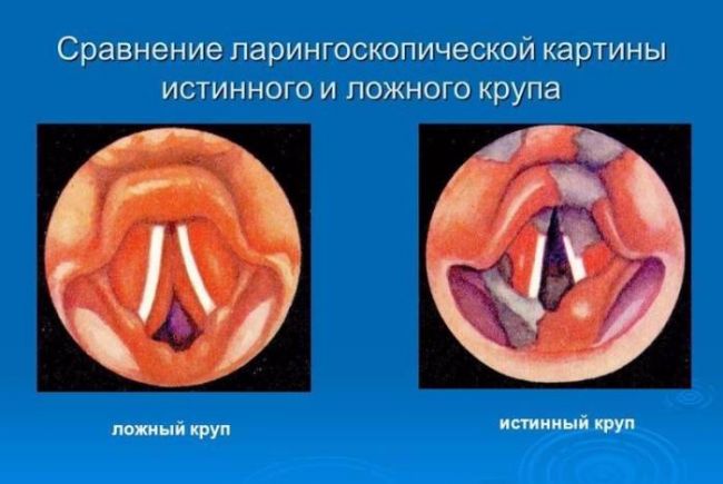 Ложный круп у детей: симптомы болезни и ее лечение в домашних условиях