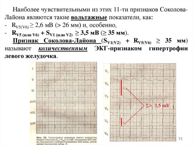 Что означает гипертрофия миокарда левого желудочка?