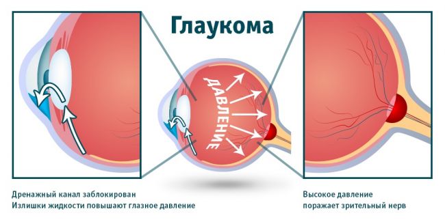 Что значит и чем опасно высокое глазное давление?