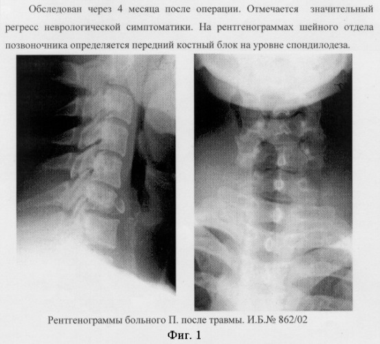 Спондилодез шейного отдела позвоночника рентген