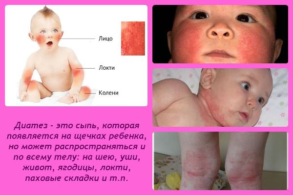 Диатез у грудничка: описание и тактика лечения