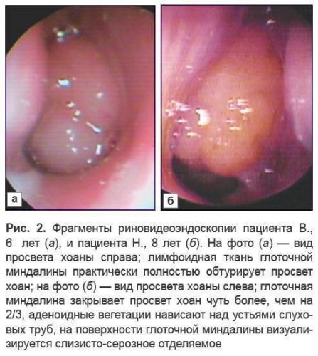 Течение и лечение лакунарной ангины