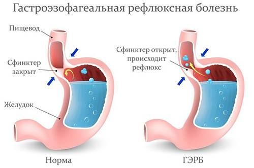 Гастроэзофагеальная рефлюксная болезнь (гэрб)