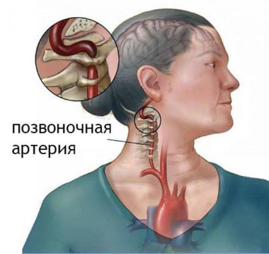 Цервикокраниалгия — что это такое, симптомы и лечение