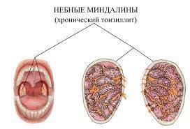 Какие антибиотики помогут при лечении тонзиллита