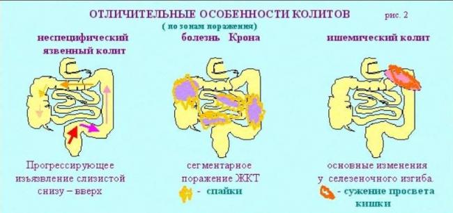 Питание при гастрите язве колите