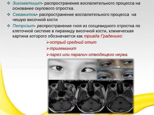 Мастоидит: характеристика, симптомы, лечение, прогноз