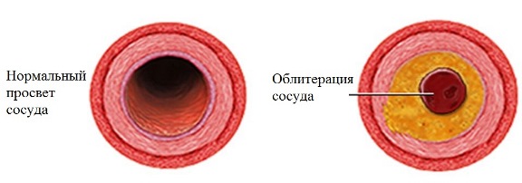 Профилактика облитерирующего эндартериита