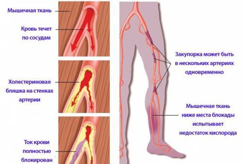 Эндартериит