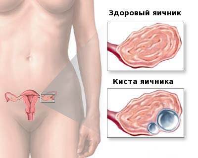 Киста левого яичника: причины и методы лечения