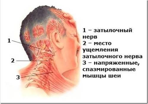 Лечение шейного остеохондроза в стадии обострения
