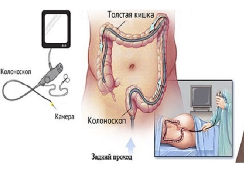 Диета при раке кишечника после операции
