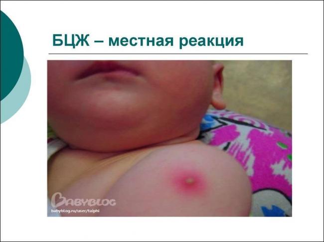 Как измерять манту и какие показатели при этом могут быть?