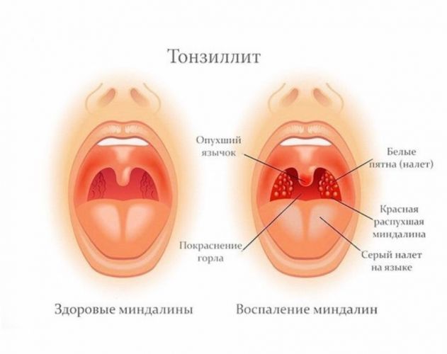Антибиотики при ангине у детей
