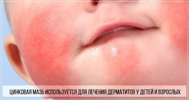 Цинковая мазь для новорожденных от опрелостей, потницы, можно ли мазать на лицо