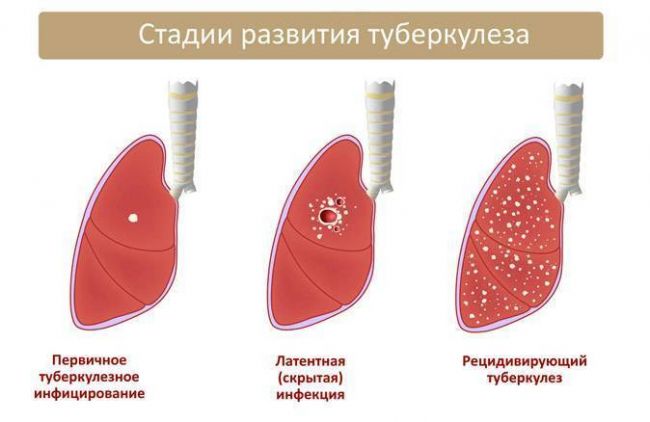 Дексаметазон для ингаляций
