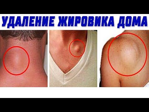 Капли для ушей при воспалении