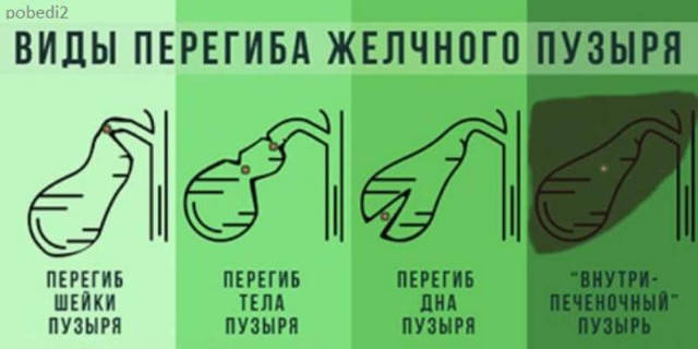 Загиб желчного пузыря у ребенка: симптомы и лечение