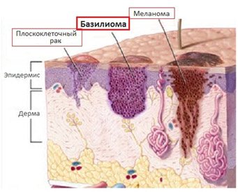 Базалиома носа: фото кожи на носу, лечение, удаление