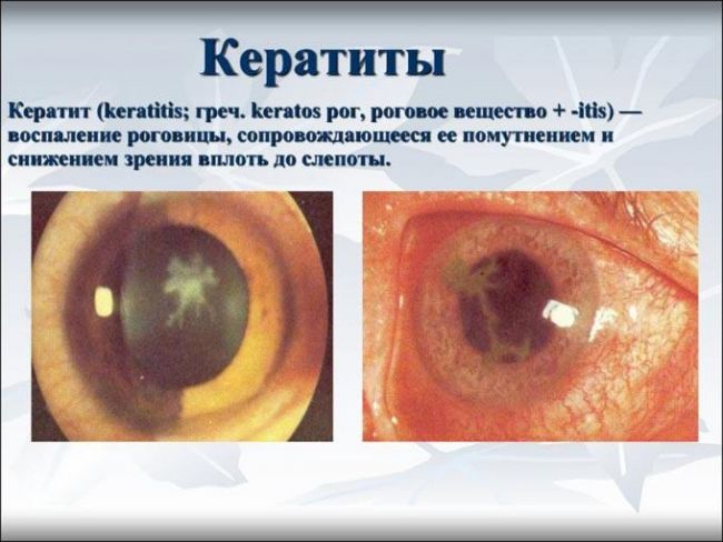 Кератит – виды, причины, симптомы и лечение воспаления глаза