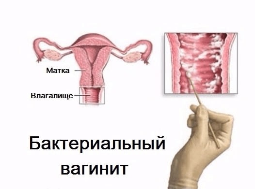 Симптомы и лечение кольпита (неспецифического вагинита)