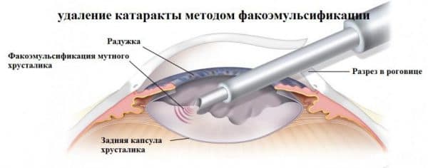 Бельмо на глазу у человека