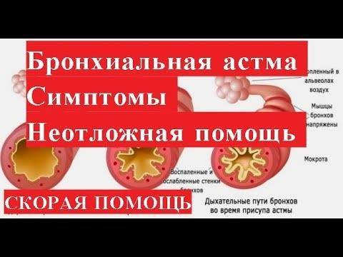 Оказание неотложной помощи при приступе бронхиальной астмы