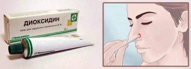 Применение Диоксидина в ухо