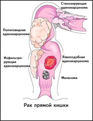 Рецепты при диете после операции на кишечнике