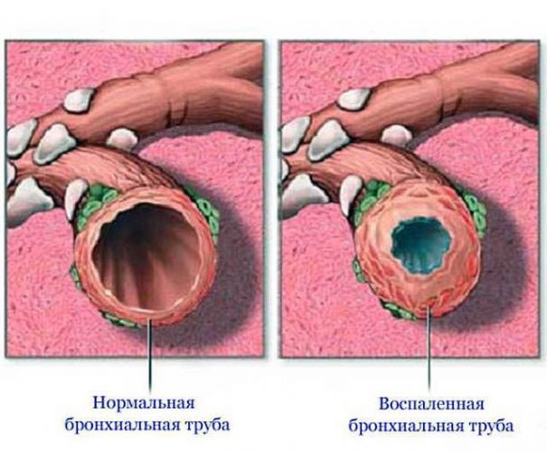 Лечение острого обструктивного бронхита