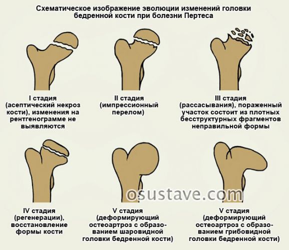 Остеохондропатии. этиология и патогенез. остеохондропатия головки бедренной кости (болезнь легга-кальве-пертеса) – диагностика, принципы лечения.
