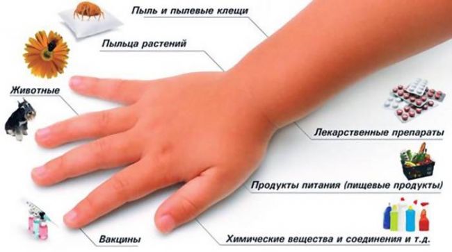 Что делать при внезапно возникшей аллергии у взрослого или ребёнка?