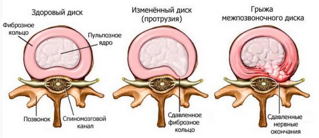 Симптомы и лечение грыжи позвоночника