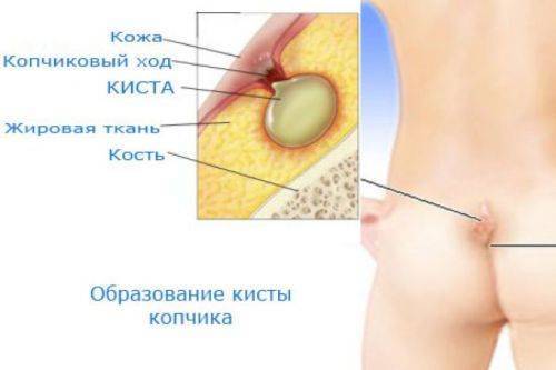 Сколько заживает киста копчика после операции