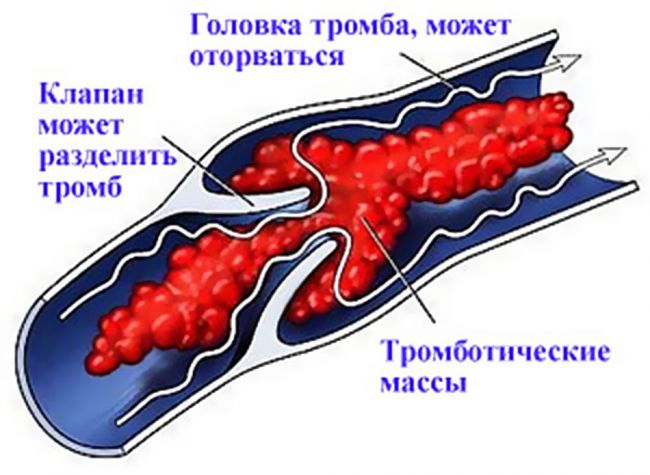 Как узнать есть ли тромбы в сосуда, от чего они образуются?
