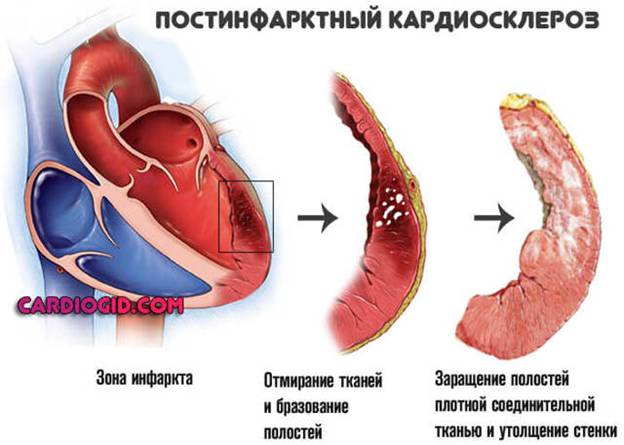 Постинфарктный кардиосклероз — причины, симптомы, диагностика и лечение — симптомы