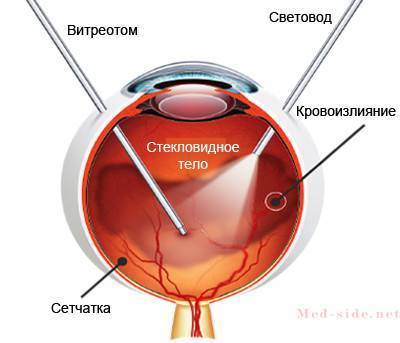 Современные подходы к лечению гемофтальма