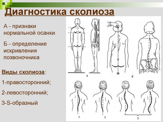Лфк при сколиозе: лучшие упражнения, правила гимнастики