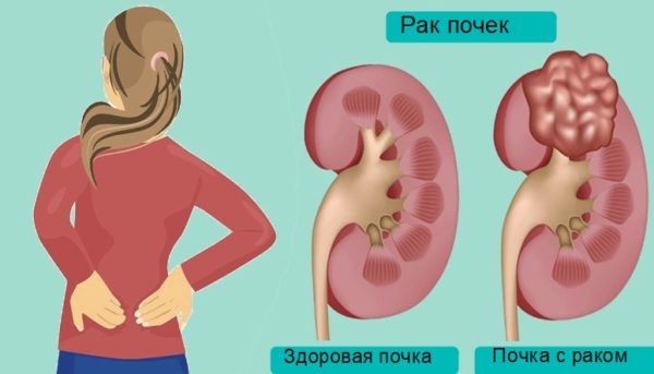Ангиолипома почки: симптоматика заболевания и его диагностика