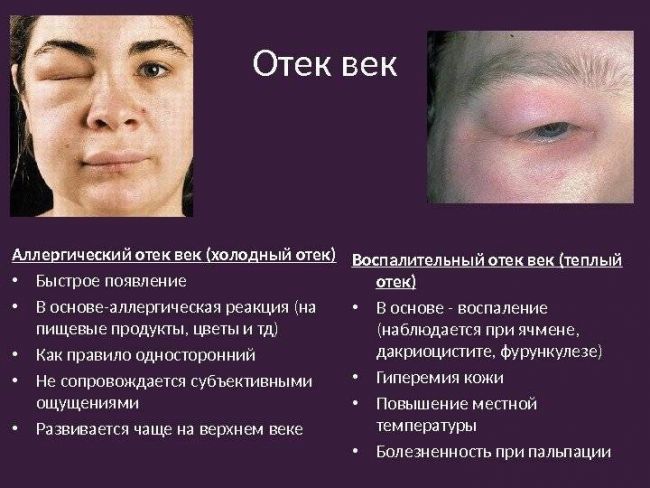 Как снять отек с верхнего века: быстро убрать дефект, что нужно срочно делать, если отекли веки