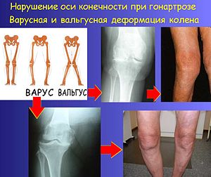 Остеоартрит – болезнь изношенных суставов