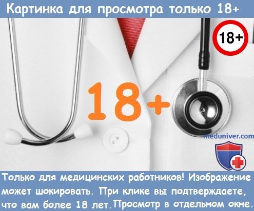 Особенности течения острого аппендицита при атипичном расположении червеобразного отростка