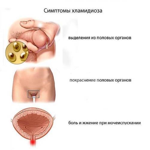Хламидиоз: признаки у мужчин и женщин, методы лечения