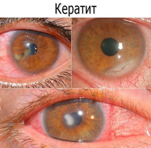 Виды и классификация кератитов с фото: грибковый, поверхностный, краевой, герпетический, нитчатый, язвенный кератит и др.